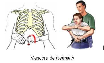 manobra de Heimlich